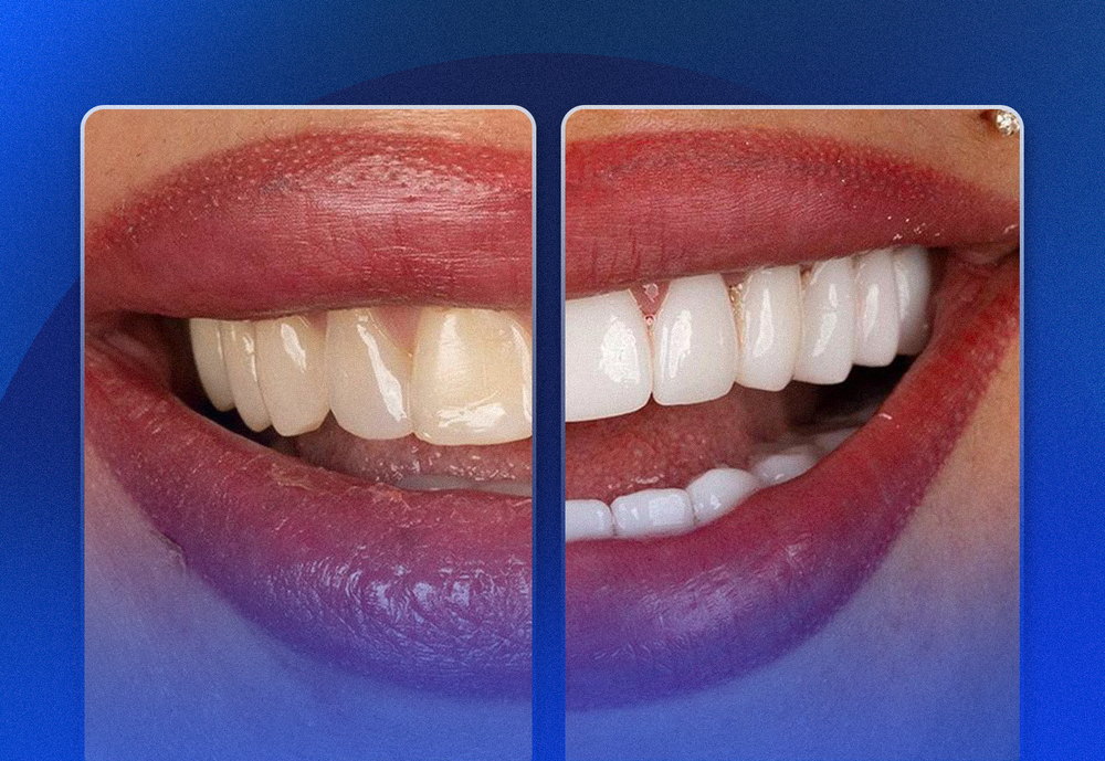 Close-up of a smile before and after cosmetic dental treatment